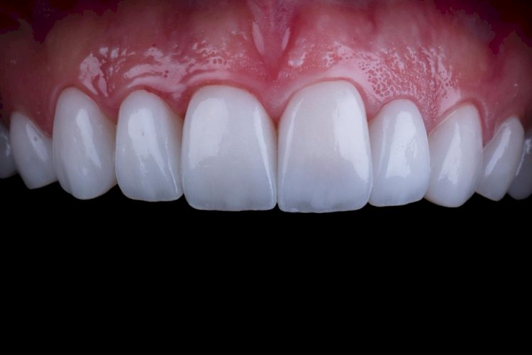 Composite Veneers and Diet: How Food Impacts Longevity