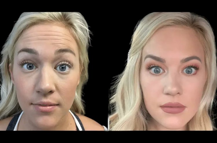 Expert Tips from the Best Doctors in dubai on Maintaining Your Botox Results