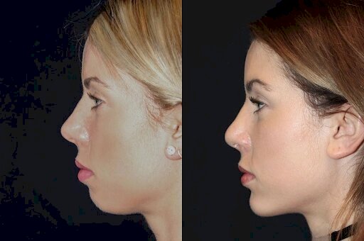 Best Doctors in dubai: Your Path to Perfect Chin Fillers