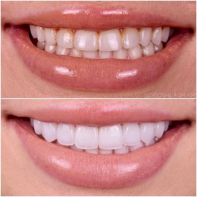 Dental Implants in Sacramento: A Complete Guide to Restoring Your Smile