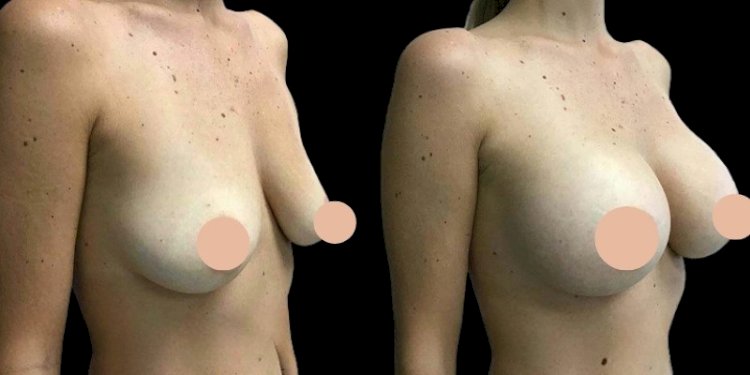 Breast Augmentation Surgery in Dubai: A Guide to Long-Term Maintenance