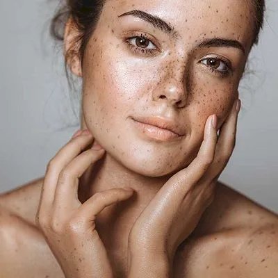 Are Natural Melasma Treatments Really Effective Long-Term?