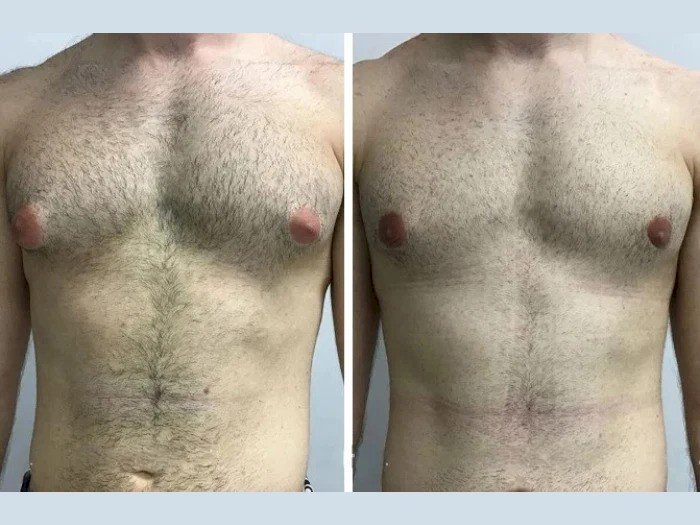 Best Gynecomastia Surgeon in Dubai: How to Read and Understand Your Diagnosis