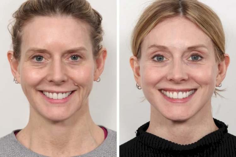Innovations in Thread Lift Technology Used by the Best Doctors in Dubai