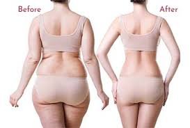 Sculpt Your Best You: Expert Body Contouring, Liposuction & 6-Pack Abs Surgery in Gurgaon