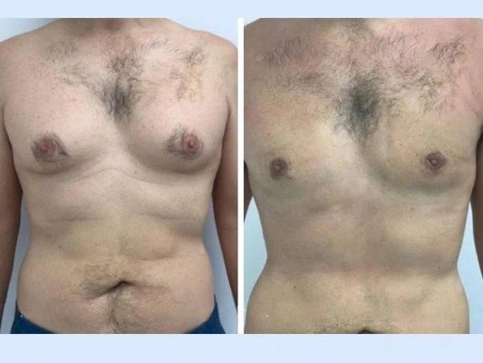 Gynecomastia Surgery In Dubai: Stunning Before and After Transformations