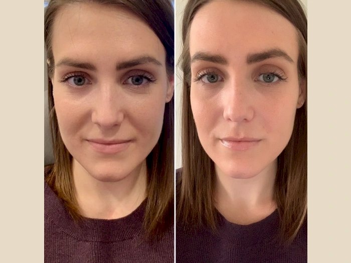 PRP Treatment in Dubai: A Complete Guide for Beginners