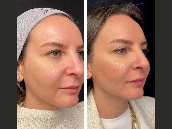 Mesotherapy Treatment in Dubai for Glowing Skin: How It Works