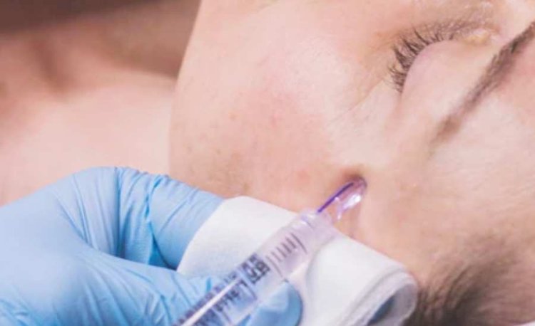 How Long Does Mesotherapy Last? A Complete Guide