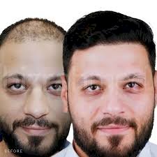 ما الذي يحدد تكلفة زراعة الشعر في الرياض؟