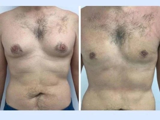 Gynecomastia in Dubai: Choosing the Right Surgeon for You