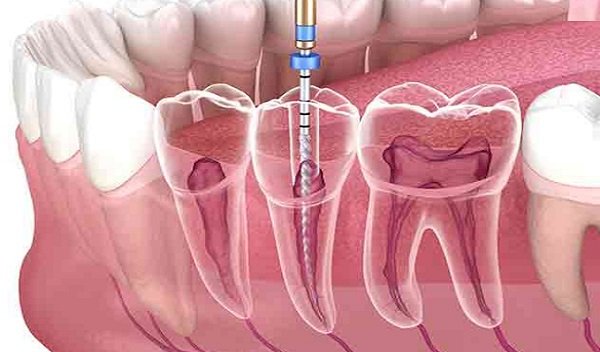 How Long Does It Take to Heal After Root Canal Treatment?