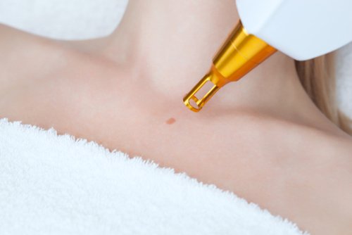 Effective Warts Removal Treatments That Actually Work Fast