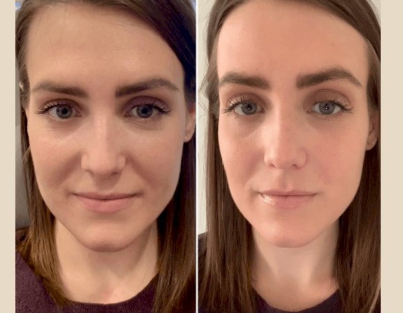 PRP Treatment in Dubai: What to Expect During Your First Session