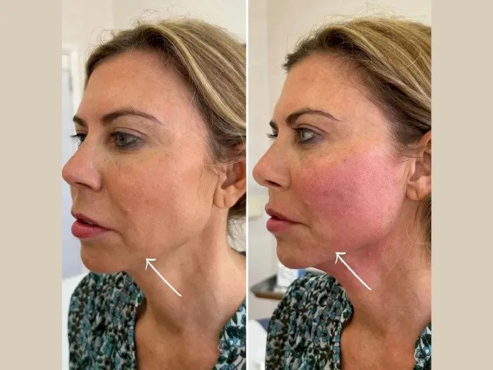 How to Prepare for Your First Endolift in Dubai – Expert Tips