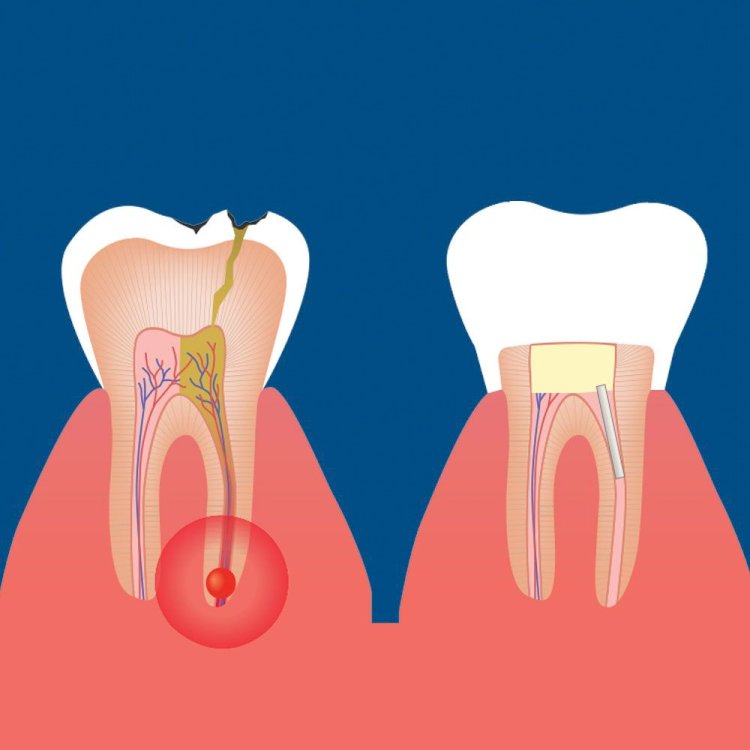 Can a Root Canal Treatment Prevent Future Tooth Pain?
