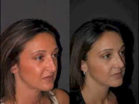 Revision Rhinoplasty in Riyadh: How to Fix a Previous Surgery