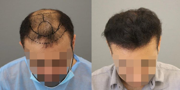 زراعة الشعر في دبي: حيث تلتقي الرفاهية بالنتائج الطبيعية المذهلة