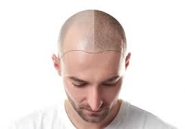 Affordable Hair Transplant in Islamabad’s F-7 and F-10 Areas