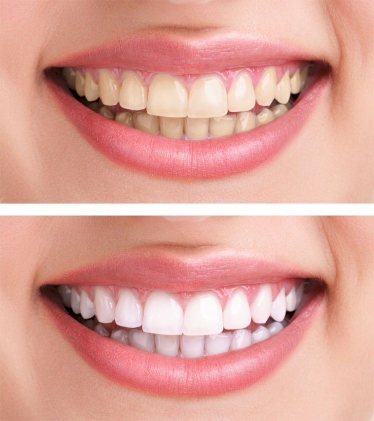 Fast Teeth Whitening Solutions in Islamabad