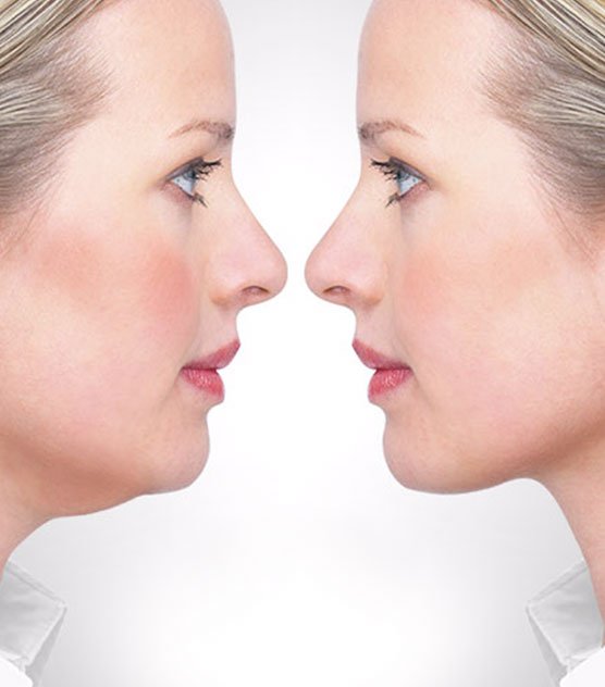 Injectable Treatments for Double Chin Reduction in Islamabad