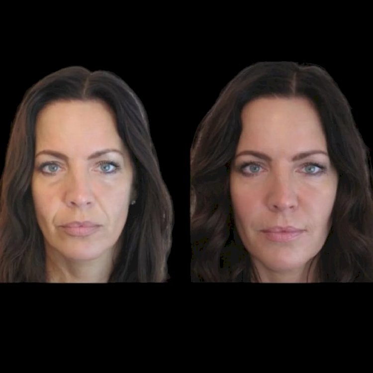 Best Plastic Surgeons in Dubai for Non-Surgical Jawline Perfection