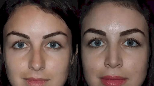 Best Rhinoplasty Surgeon in Dubai for Advanced Rhinoplasty Care