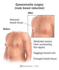 Tips to Manage Gynecomastia Surgery Cost in Islamabad Without Compromising Safety