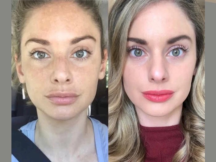 Visible Results with Radiofrequency (RF) Microneedling by the Best Aesthetic Clinic in Dubai